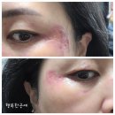 발안제일의원 | 기미시술 중간 점검 해볼께요 - 오늘로 시술 2주차