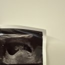 포항시남구보건소 | 산전검사지원 e보건소 : 포항 남구보건소, 포항여성병원 검사 후기 | 비용 청구 • 환급 기간 💸