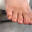 문제성 손, 발 오감네일 이미지