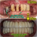 이심는치과의원 | 전체 임플란트의 가격과 과정 및 후기, 뼈이식이 필요한 상악동 거상술(주안치과)