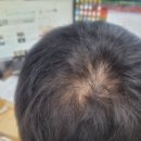 세라젬 두피디바이스 헤어미라클 한 달 사용후기