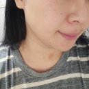 멍스타일 | 대구 동성로 얼굴 이중턱람스 멍 붓기 당일 후기