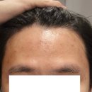 영 에스테틱(Young aesthetic) | 안산 중앙동 남자 피부관리 전문 영에스테틱 :: 악성 여드름 관리 면포성 트러블 관리