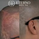 지축지구 | 원흥지구ㆍ 삼송지구ㆍ 지축ㆍ 향동ㆍ 도래울마을 두피문신 가격