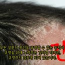 욕창 원인과 치료방법 - 사암오행침, 사암침법, 오행침, 정통사암침 이미지
