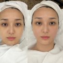웨딩 텐션업 윤곽관리 전후사진 솔직후기 | 루아에스테틱 마곡점