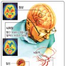 뇌질환 이미지