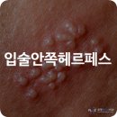 클로버치과의원 | 입술안쪽헤르페스 수포 물집 부음 염증 재발 면역력