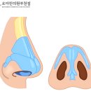 도계한의원 | 코수술전필러, 시술 받고 수술포기하는 이유?