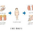 쿠싱증후군 원인 증상 진단 치료 이미지