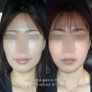 닥터부스터 - 서구 둔지로 36 | 여의도피부과 올리디아 콜라겐부스터 닥터펠프스 키닥터 시술 후기, 효과