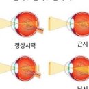 난시 원인 난시 근시 차이 안경 시력교정렌즈 필요성 이미지