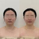 온에스테틱 아카데미 | [청주 율량동 피부관리] 피다에스테틱 윤곽관리 후기