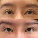 수아이성형외과의원 | 앞트임복원 수술 지제이성형외과 전후 후기 개선 후 모습 (어색함과 흉터 해결)