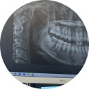 남스힐링치과의원 | 잠실숲사랑니치과 매복 누운 사랑니 발치 후기(사랑니맛집/예약필수)