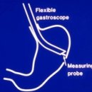 위내시경(Gastroscopy) 이미지