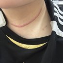 큐리코 | 갑상선암 대구 동위원소 150큐리 입원 및 후기