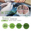 행신준재활의학과의원 | 생긴 피멍, 알고 보니 무좀까지… 발톱무좀 2개월 만에 깨끗하게 회복한 사례” 행신동 유앤미재활의학과