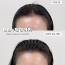 O:Na(오나) | 오나뷰티 M자 헤어라인 커버 후기 일산두피커버 장항동 라페스타