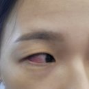 온누리수경약국 | 2025.09.29.월 결막모반제거