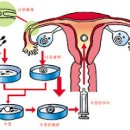 체외수정 시험관 과정 (난자 채취) 이미지