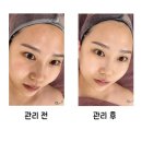 이천피부관리 뷰티더연 고보습물광톡스 후기