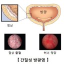 간질성 방광염 이미지