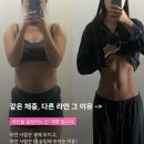 수지척추체형교정