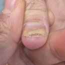 노란 | 압구정로데오역 네일샵, 무좀 노란 손톱 관리 후기