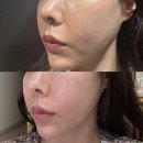 더신사의원 | 3DEEP의 즉각적인 리프팅, 더신사의원 솔직 후기!