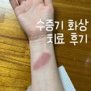 화사의원 | 수증기 화상 | 천안 화상전문병원 &lt;화사의원&gt; 2도화상 치료 후기