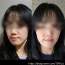 용산-300 | 용산역피부과 리프팅 리니어지 300샷 : 일상생활, 붓기, 통증 후기