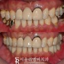 한 번에 많은 치아 치료해야 된다면? 사당역 치과 수면 임플란트 로 편안하게