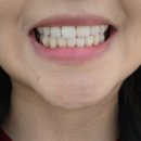 서울미소담은치과의원 | 강남 치아미백 치과 다녀왔어요 '레브치과' 누런이 고민해결 후기