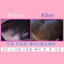 두피 탈모 아미치 0.3 수원점 이미지