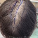 오로지생돈 | [모발이식] 여성 정수리 탈모 이식한 후 4일차 후기 (1) - 약혐사진주의