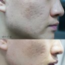 스킨룩스한의원 | 건선크림 흉터크림 : 스킨룩스크림 여드름피부 사용 후기