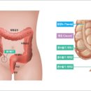 맹장염 초기 급성만성위치 이미지