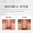 최우식노즈립성형외과의원 네이버블로그