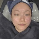 일성수영장 | 신사역피부과 내돈내산 온다 리프팅 8만줄 볼패임 부작용 리얼후기