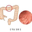게실 [diverticulum, 憩室]과 게실염[diverticulitis, 憩室炎] 이미지