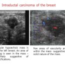 Intraductal carcinoma of the breast 이미지