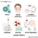 악성림프종 이미지