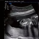 동네중기 | [임신 21주차] 임신 중기 정밀초음파 후기 검사 소요시간, 자궁경부 길이, 17주차 피묻음, 피비침 증상 등.