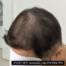 정수리 이미지