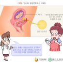 갑상선기능저하증 이미지