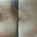 (주)피앤알 | 여드름스킨로션 2일 무료사용 효과대박
