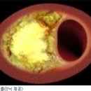 고지혈증 제대로알자 이미지