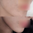 구로-구로-구로-1080 | 하이필스킨 구로피부관리 여드름흉터전문 색소침착 필링 후기