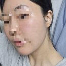 이솔한의원 | 지루성피부염 항생제 단약 일주일차 피부염 스킨케어 루틴 기초제품 화장품 클렌징 선크림/ 피부염 극복...